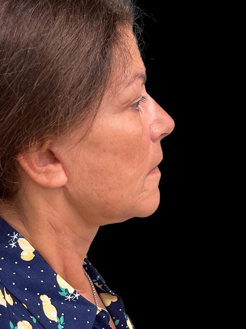 Necklift Before & After Gallery - Patient 338101 - Image 10