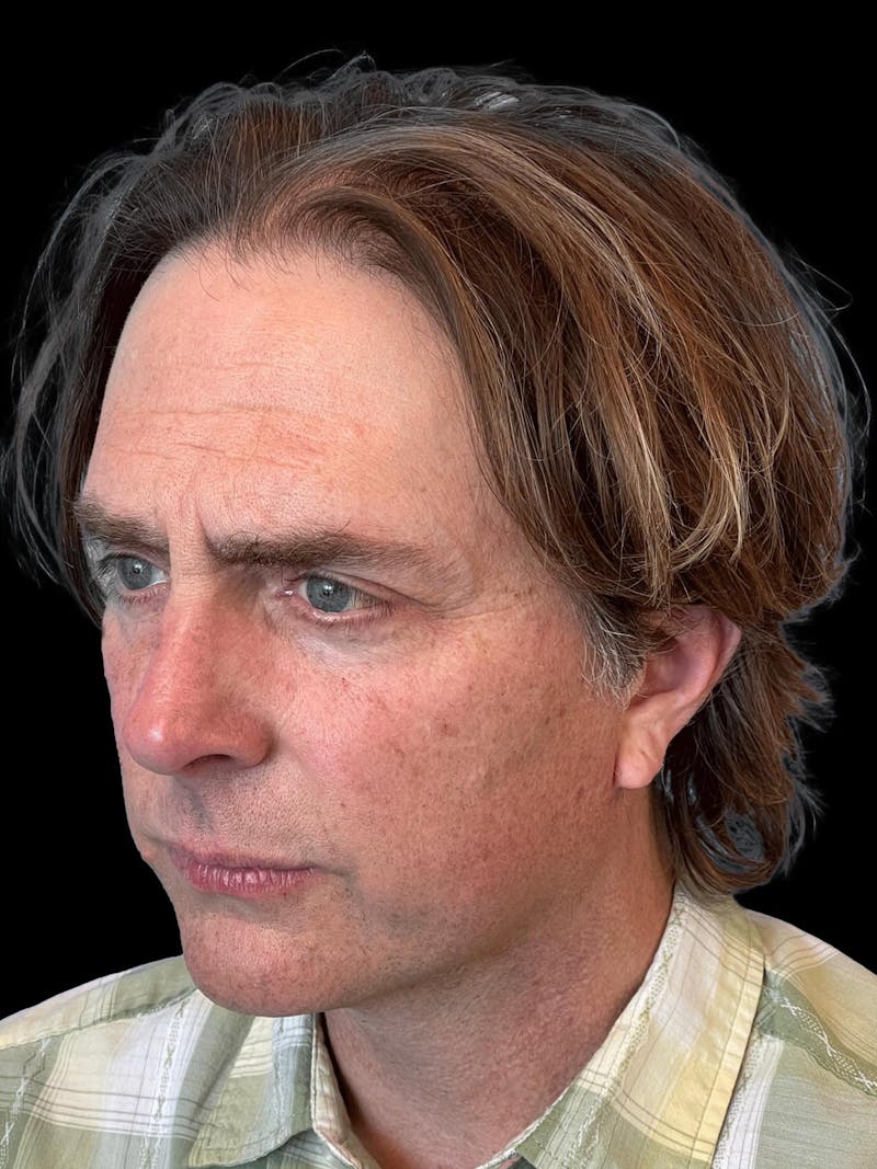 Necklift Before & After Gallery - Patient 388281 - Image 4