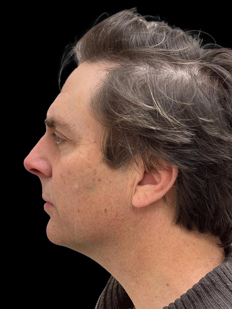 Necklift Before & After Gallery - Patient 388281 - Image 5