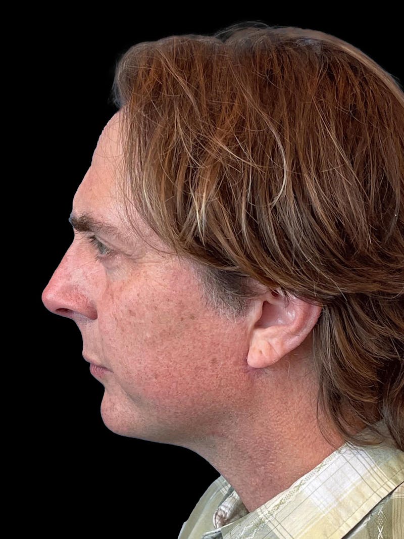 Necklift Before & After Gallery - Patient 388281 - Image 6