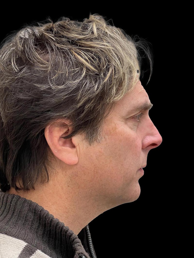 Necklift Before & After Gallery - Patient 388281 - Image 9