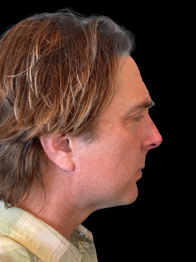 Necklift Before & After Gallery - Patient 388281 - Image 10