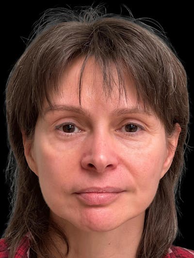Facelift Before & After Gallery - Patient 111818 - Image 2