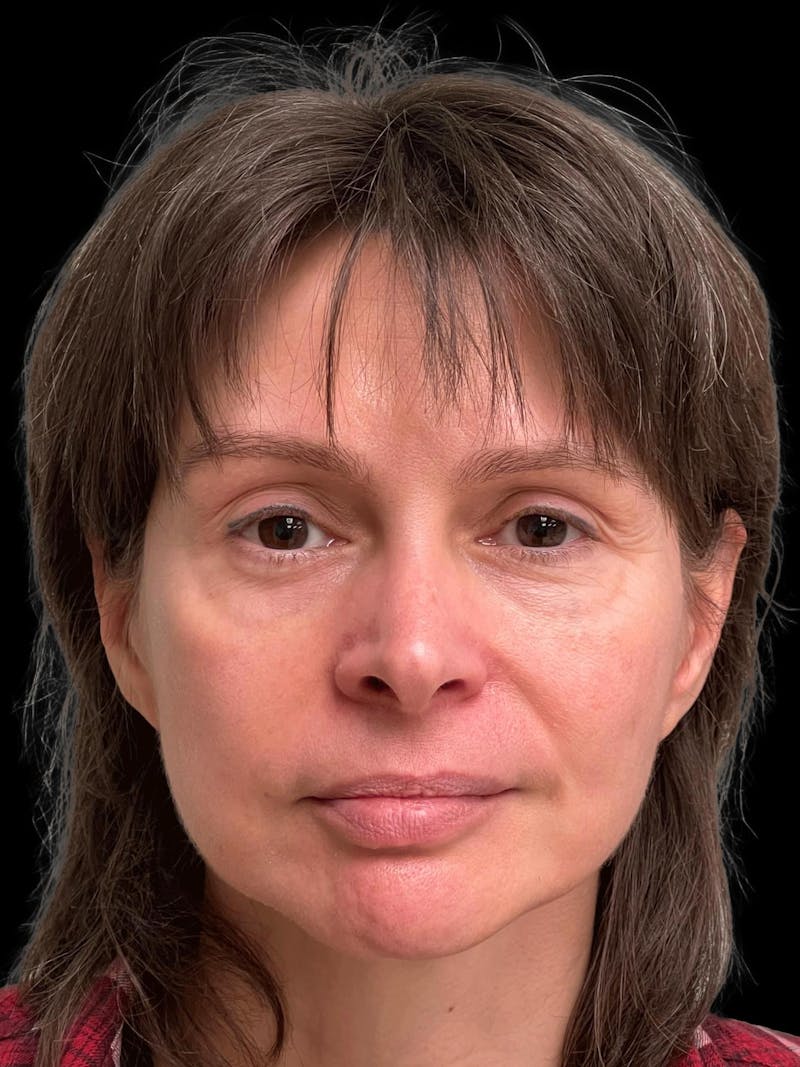 Facelift Before & After Gallery - Patient 111818 - Image 2