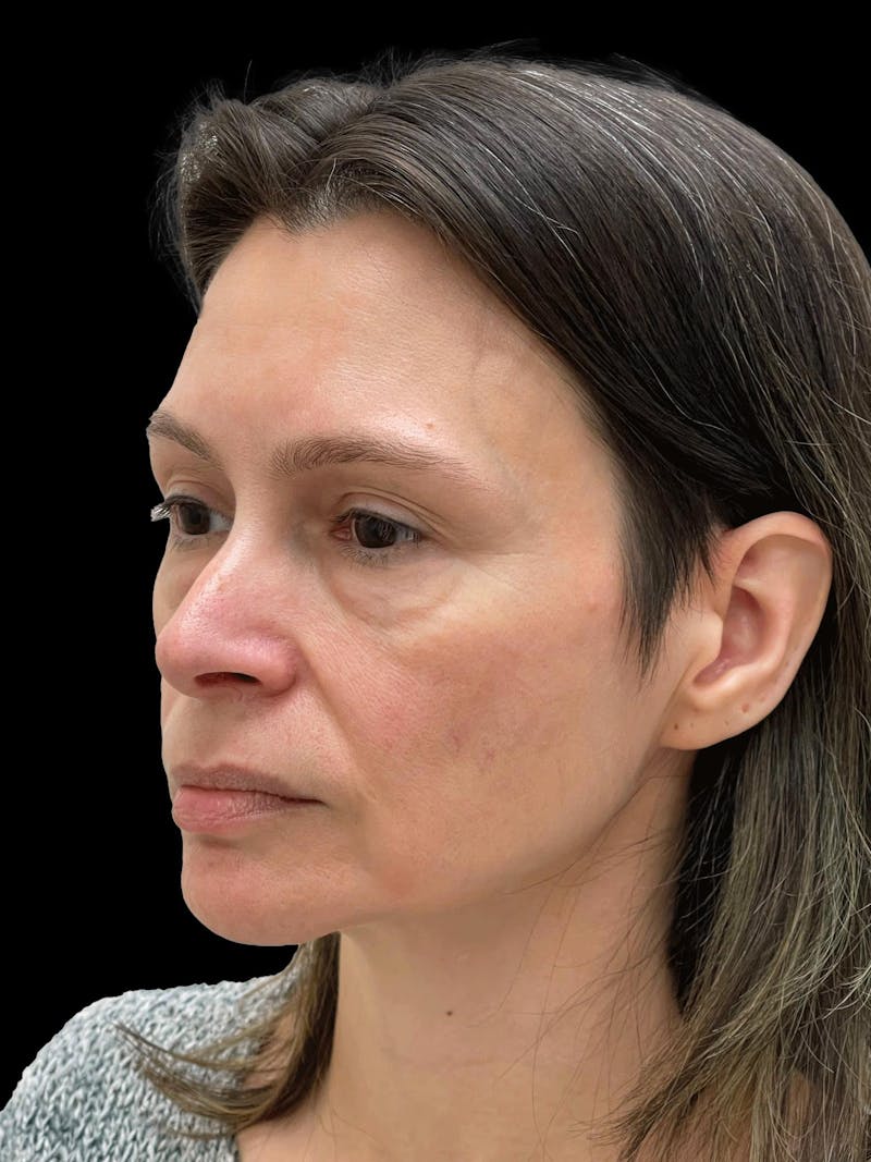 Facelift Before & After Gallery - Patient 111818 - Image 3