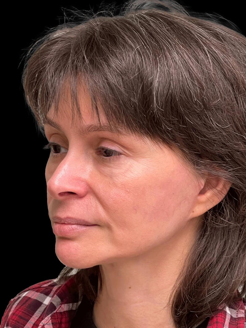 Facelift Before & After Gallery - Patient 111818 - Image 4