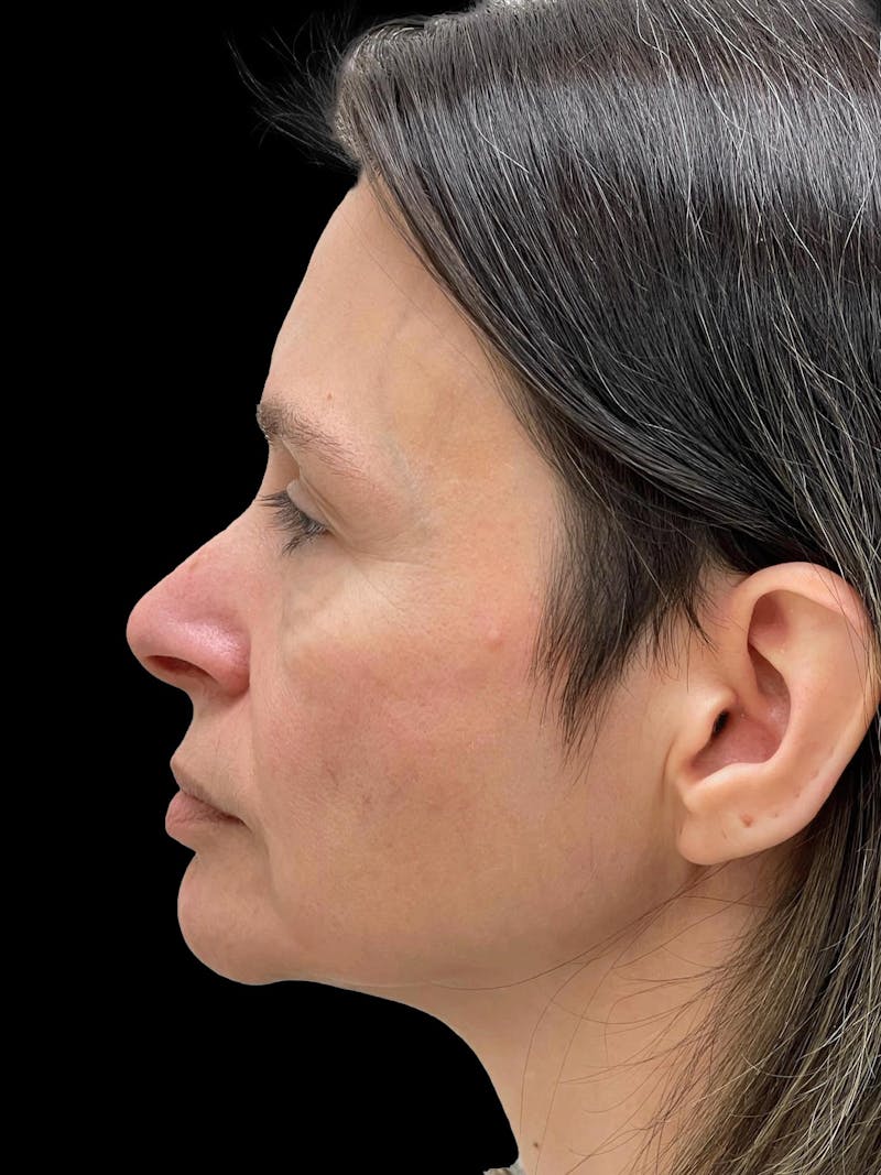 Facelift Before & After Gallery - Patient 111818 - Image 5