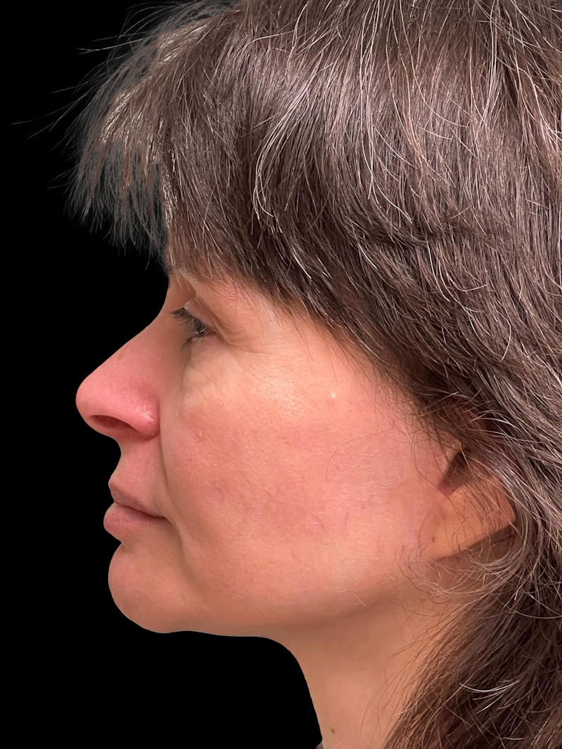 Facelift Before & After Gallery - Patient 111818 - Image 6