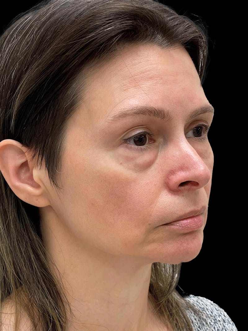 Facelift Before & After Gallery - Patient 111818 - Image 7
