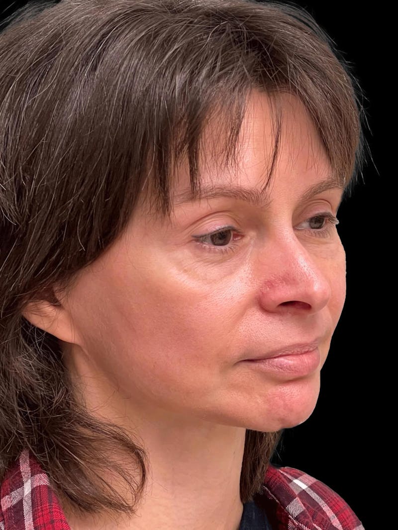 Facelift Before & After Gallery - Patient 111818 - Image 8