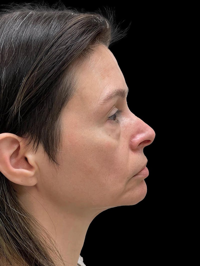 Facelift Before & After Gallery - Patient 111818 - Image 9