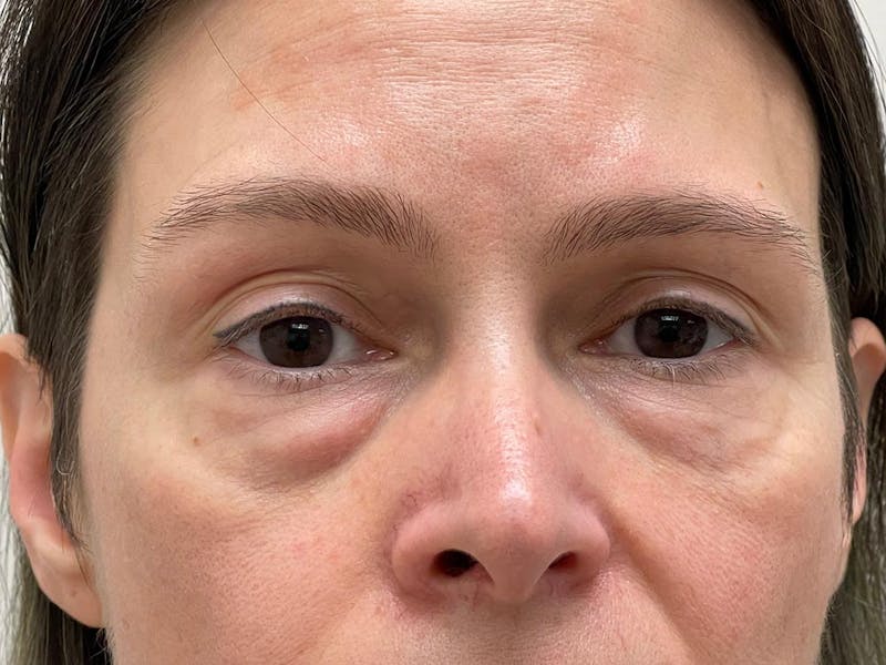 Blepharoplasty Before & After Gallery - Patient 241354 - Image 11