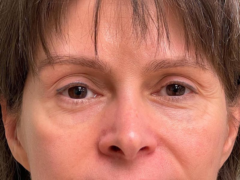 Blepharoplasty Before & After Gallery - Patient 241354 - Image 12
