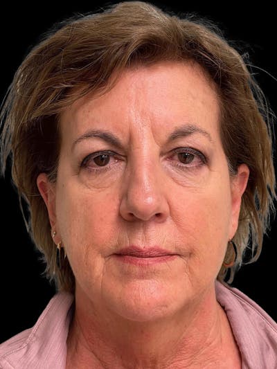 Necklift Before & After Gallery - Patient 552891 - Image 1