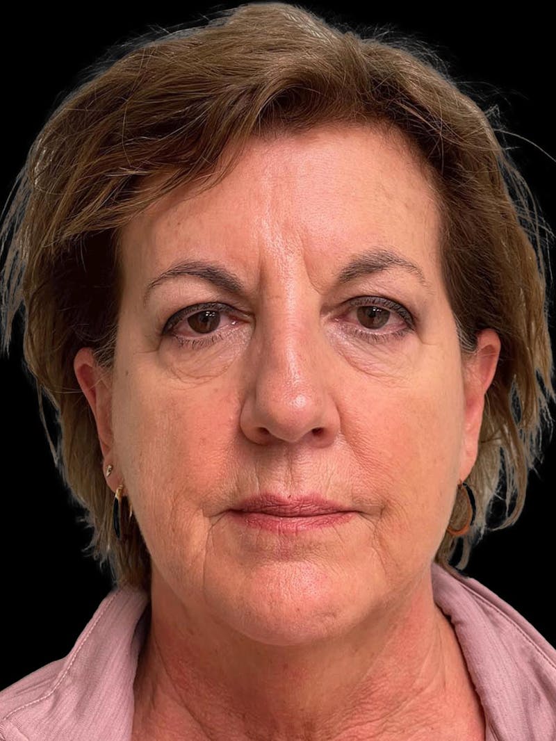 Necklift Before & After Gallery - Patient 552891 - Image 1