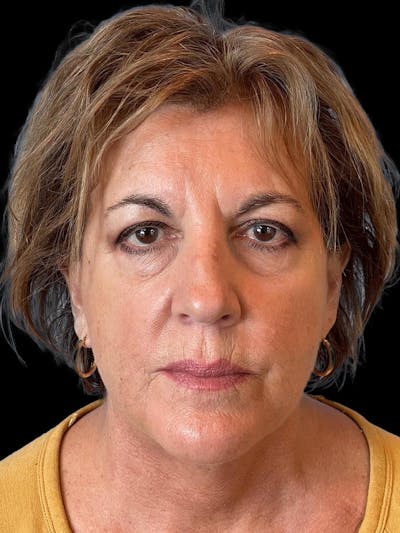 Necklift Before & After Gallery - Patient 552891 - Image 2