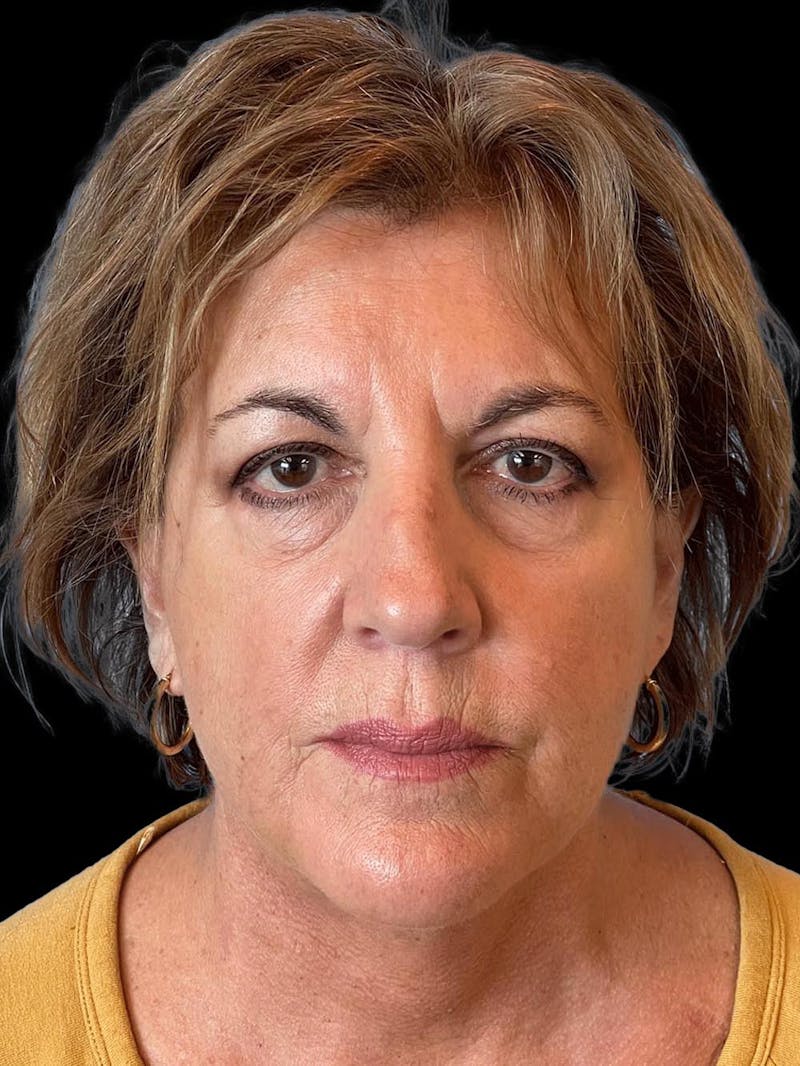 Necklift Before & After Gallery - Patient 552891 - Image 2