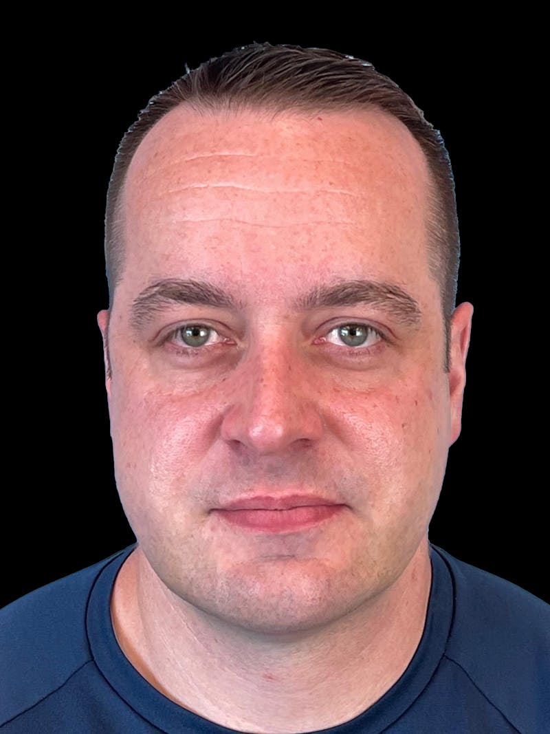 Necklift Before & After Gallery - Patient 151878 - Image 2