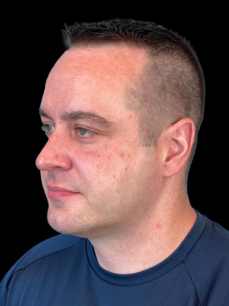Necklift Before & After Gallery - Patient 151878 - Image 4