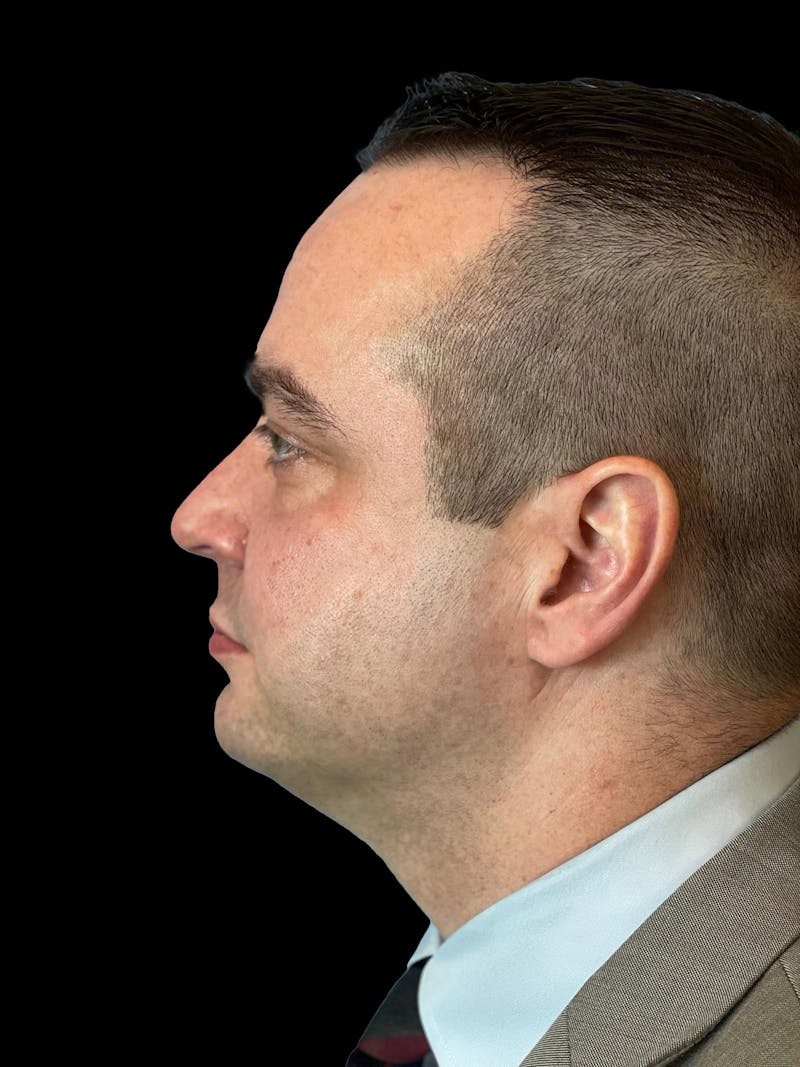Necklift Before & After Gallery - Patient 151878 - Image 5