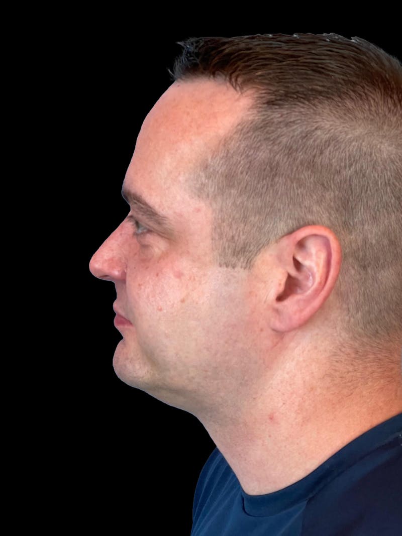 Necklift Before & After Gallery - Patient 151878 - Image 6