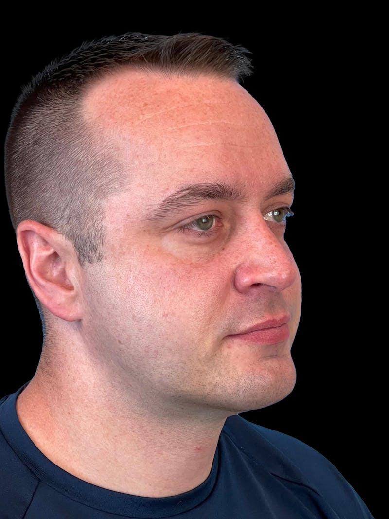 Necklift Before & After Gallery - Patient 151878 - Image 8