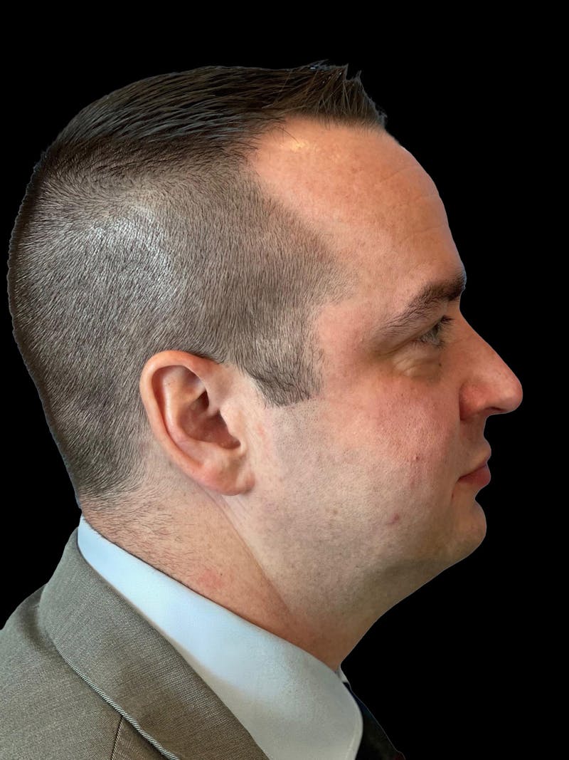 Necklift Before & After Gallery - Patient 151878 - Image 9