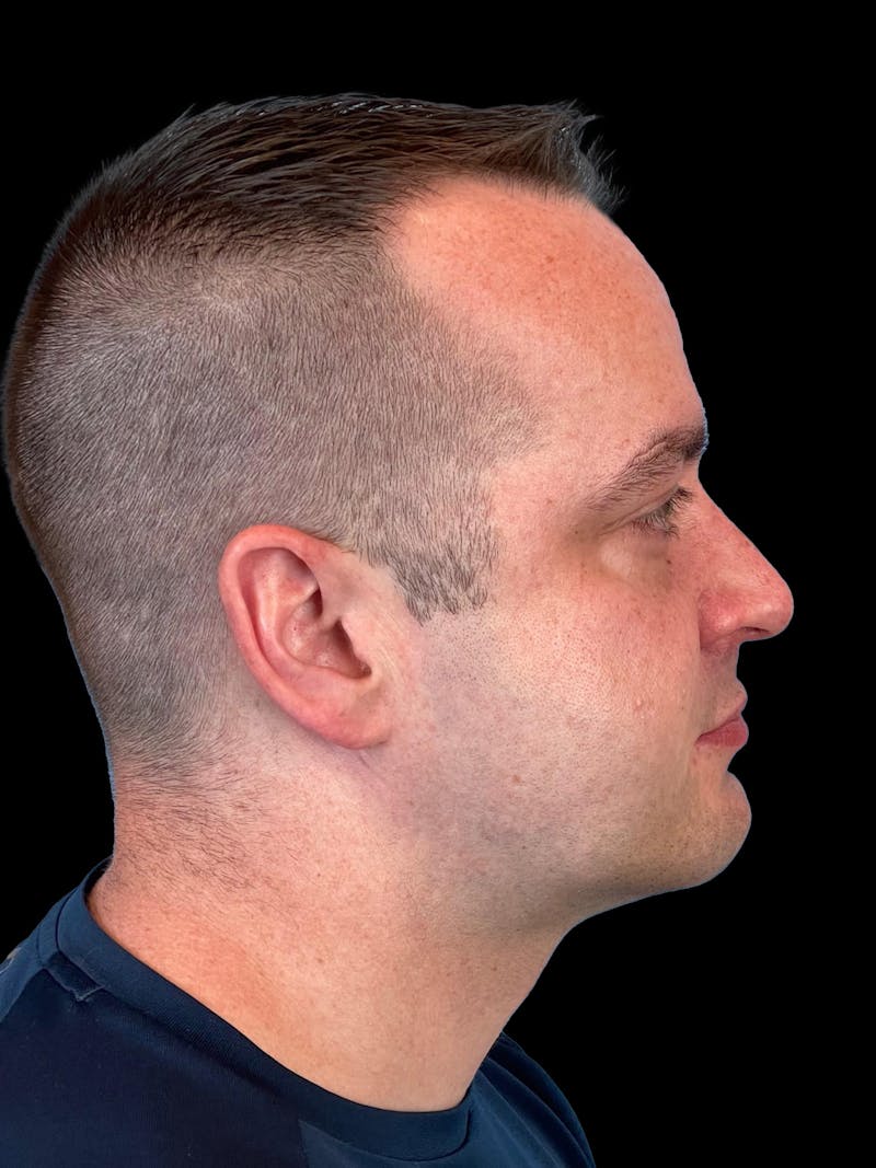 Necklift Before & After Gallery - Patient 151878 - Image 10