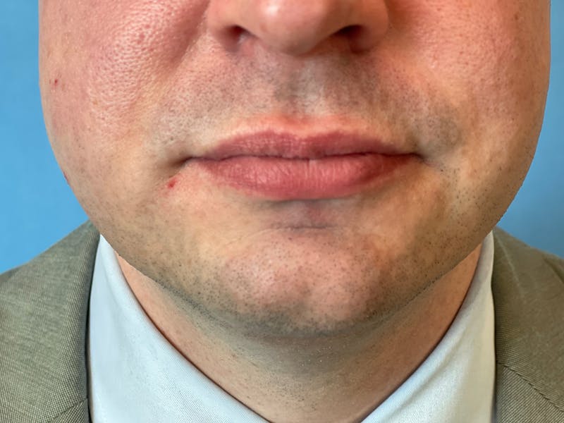 Necklift Before & After Gallery - Patient 151878 - Image 11