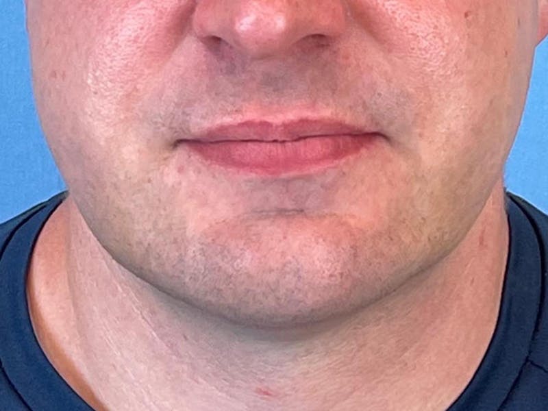 Necklift Before & After Gallery - Patient 151878 - Image 12