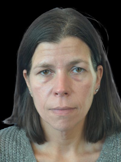 Necklift Before & After Gallery - Patient 113382 - Image 1