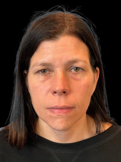 Necklift Before & After Gallery - Patient 113382 - Image 2