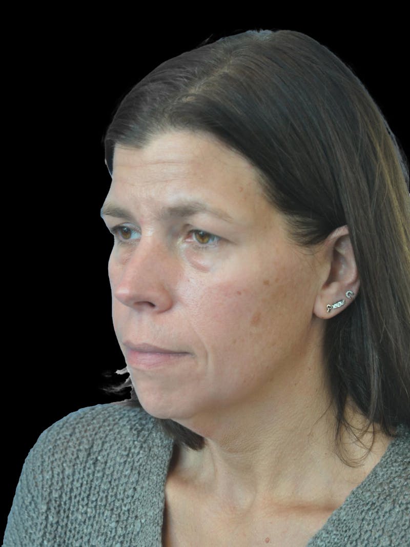 Necklift Before & After Gallery - Patient 113382 - Image 3