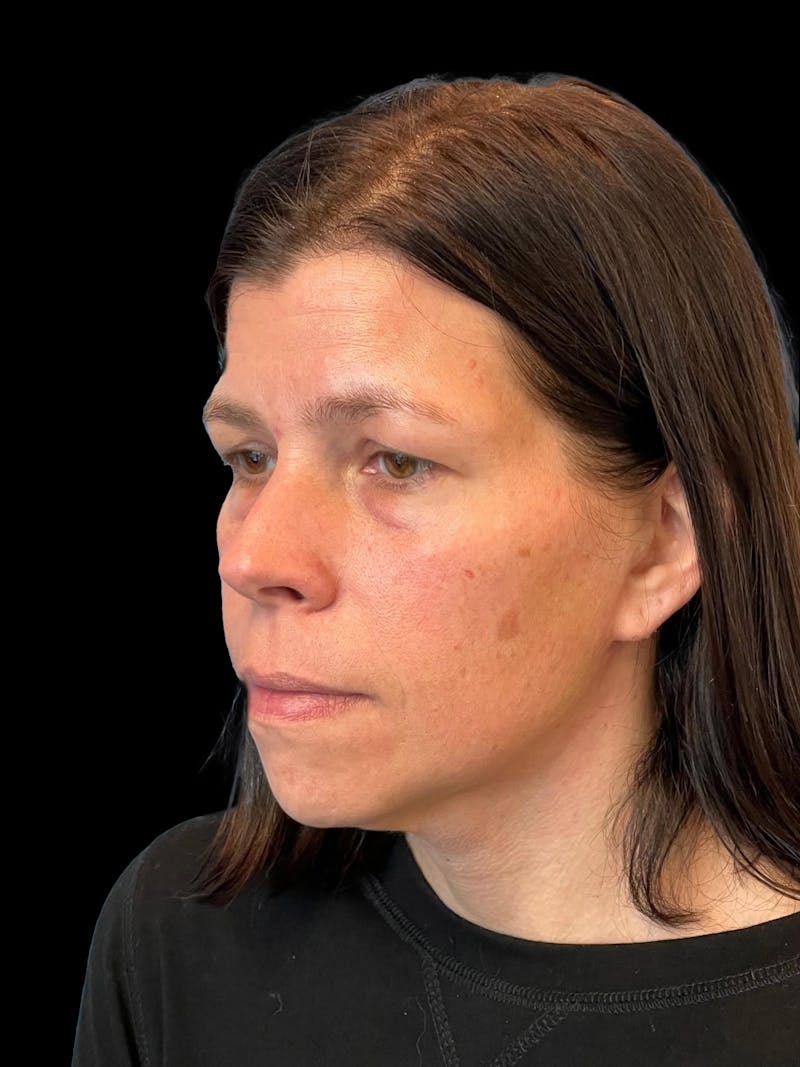 Necklift Before & After Gallery - Patient 113382 - Image 4