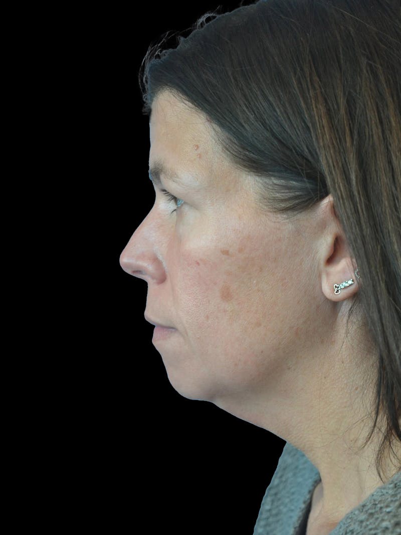 Necklift Before & After Gallery - Patient 113382 - Image 5