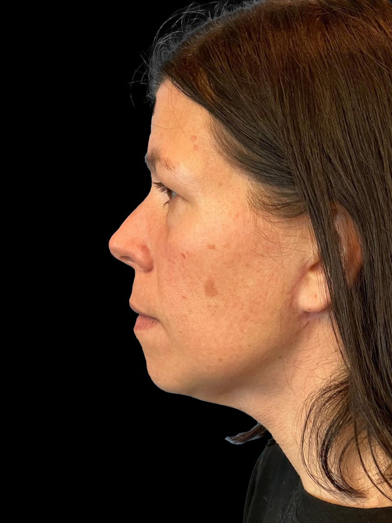 Necklift Before & After Gallery - Patient 113382 - Image 6