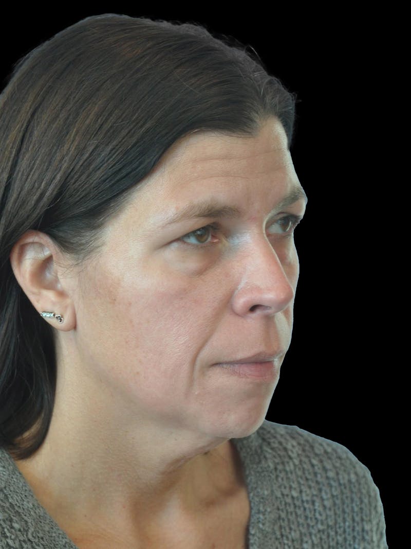 Necklift Before & After Gallery - Patient 113382 - Image 7