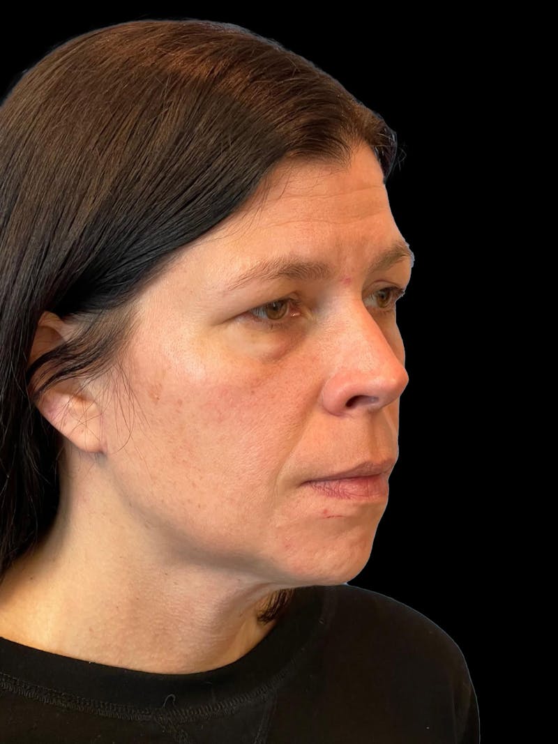 Necklift Before & After Gallery - Patient 113382 - Image 8