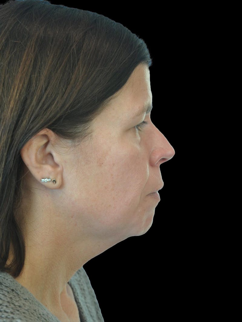 Necklift Before & After Gallery - Patient 113382 - Image 9