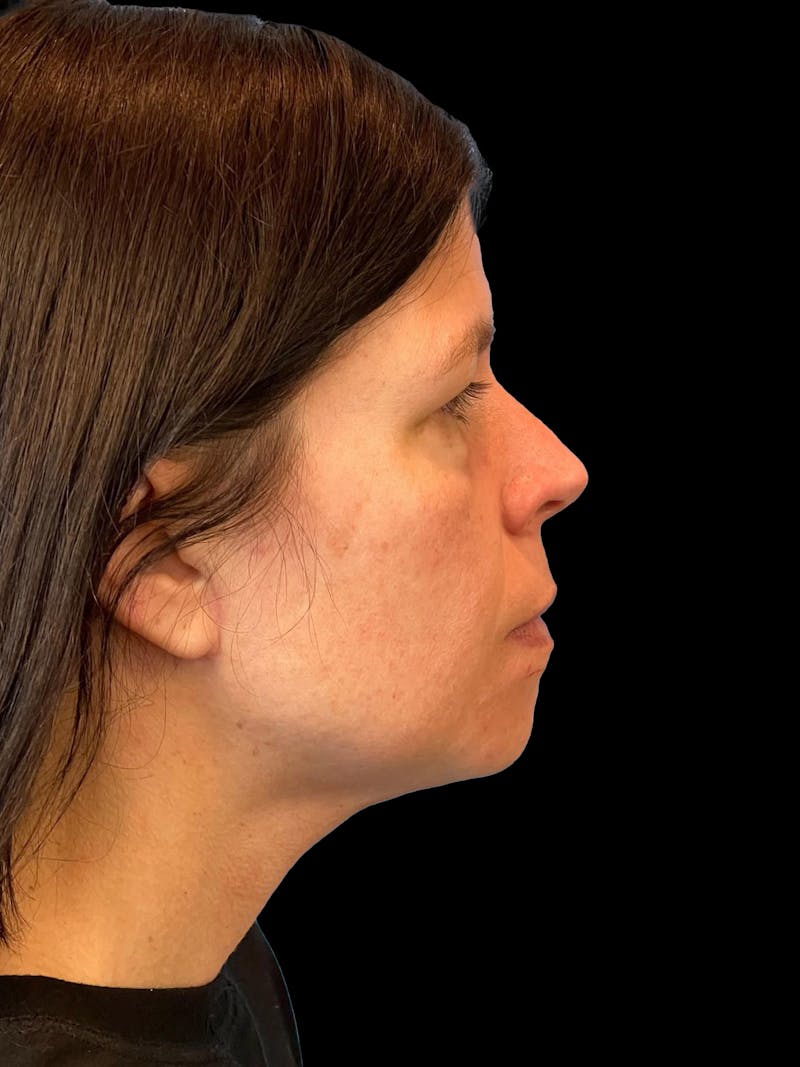 Necklift Before & After Gallery - Patient 113382 - Image 10
