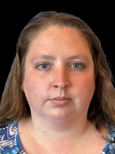 Necklift Before & After Gallery - Patient 683068 - Image 1