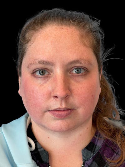 Necklift Before & After Gallery - Patient 683068 - Image 2