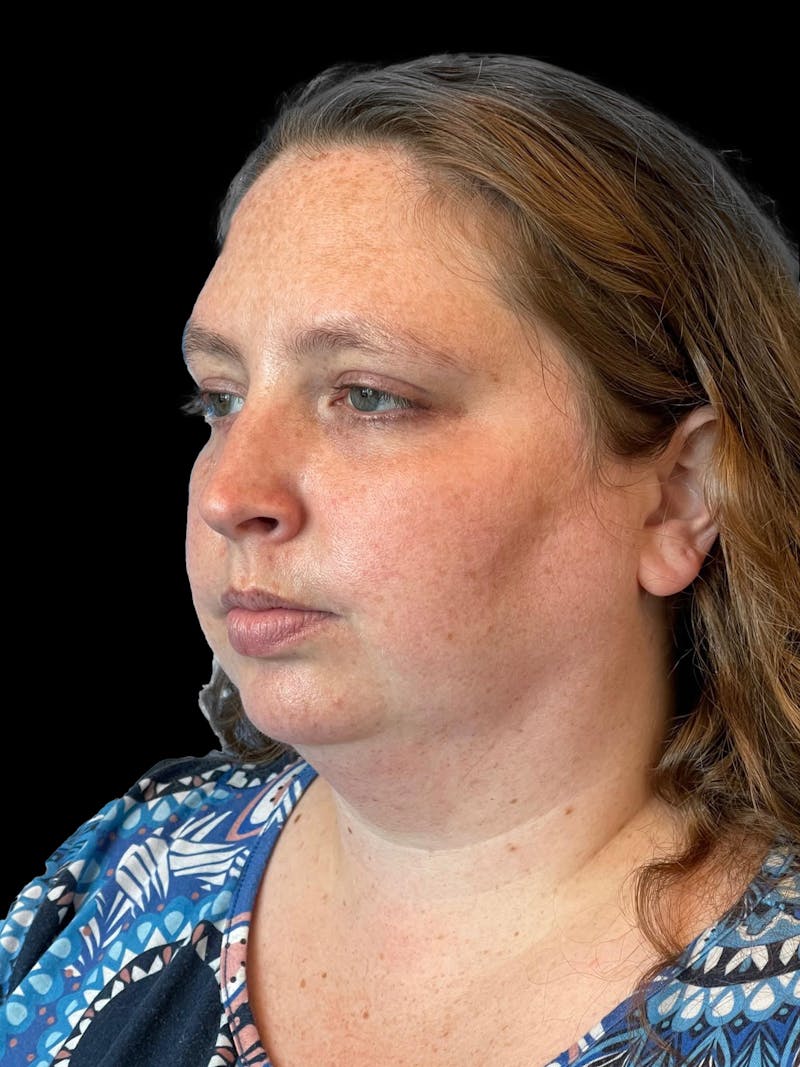 Necklift Before & After Gallery - Patient 683068 - Image 3