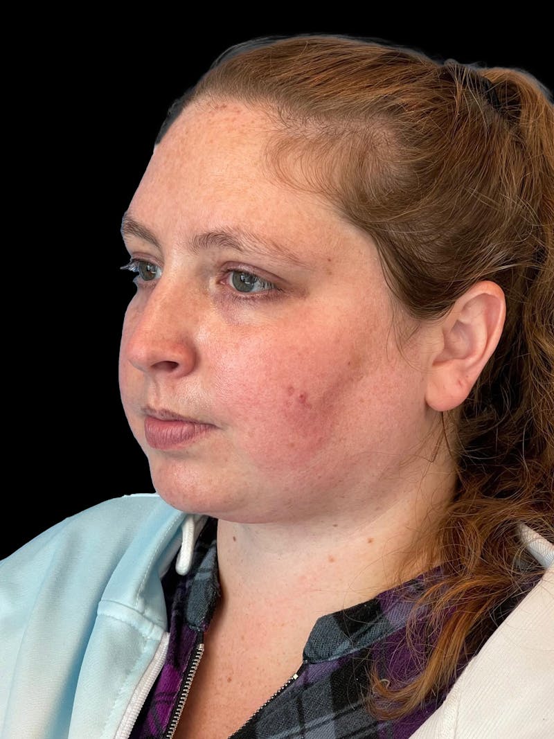 Necklift Before & After Gallery - Patient 683068 - Image 4