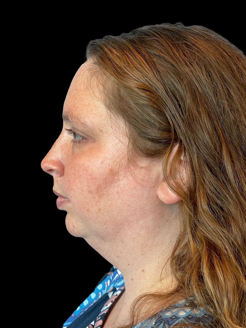 Necklift Before & After Gallery - Patient 683068 - Image 5