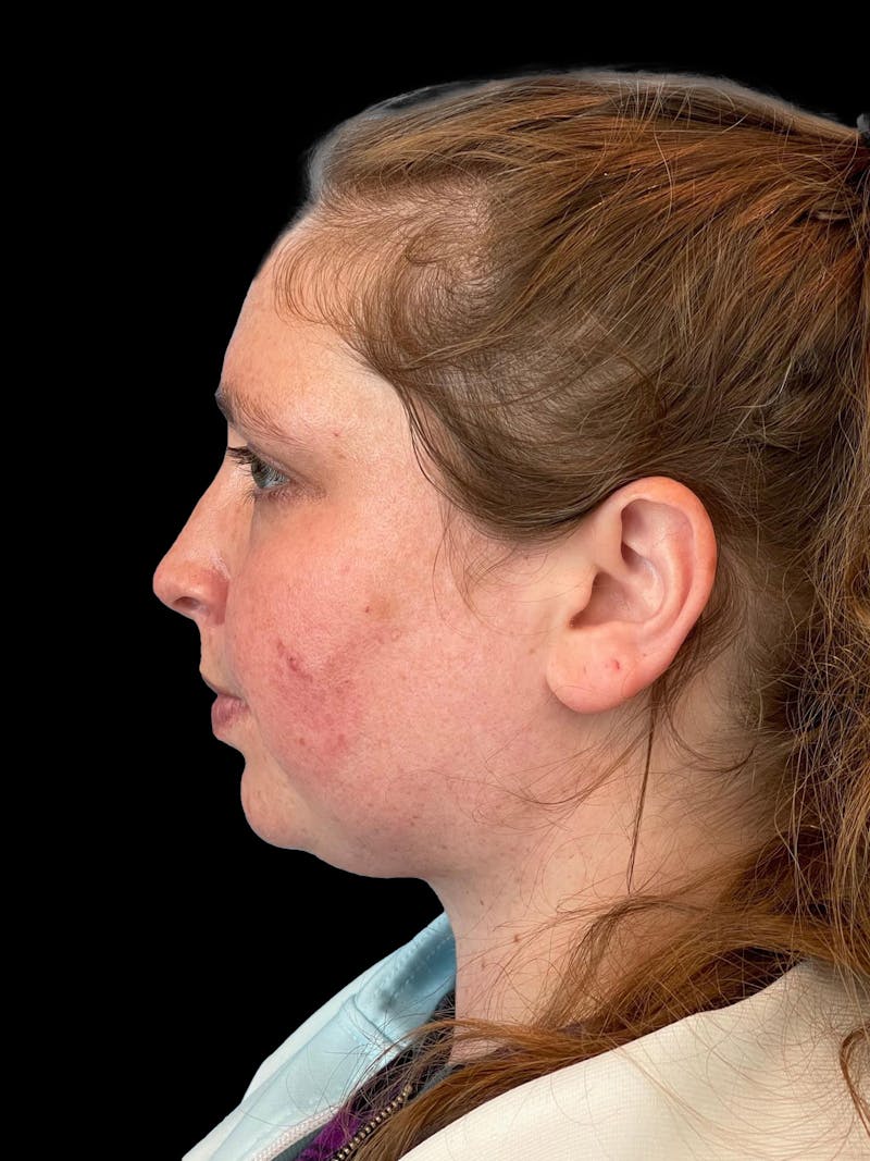 Necklift Before & After Gallery - Patient 683068 - Image 6