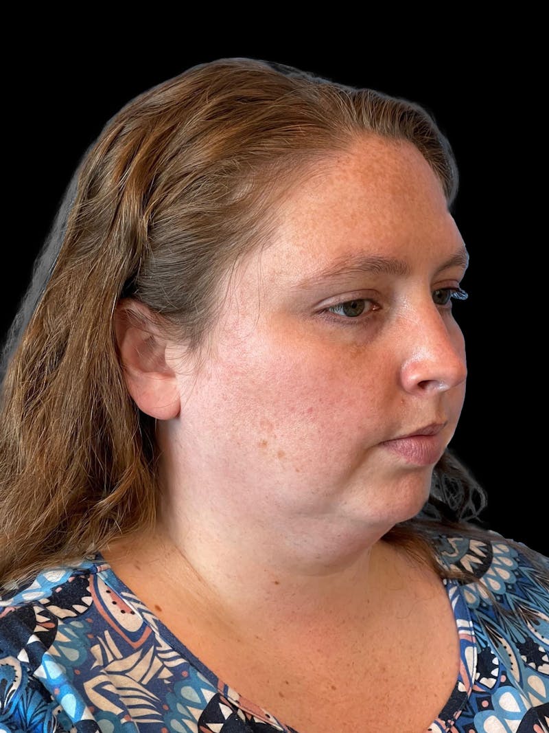 Necklift Before & After Gallery - Patient 683068 - Image 7