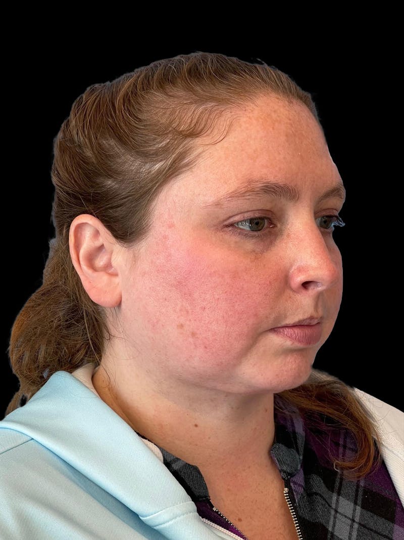 Necklift Before & After Gallery - Patient 683068 - Image 8