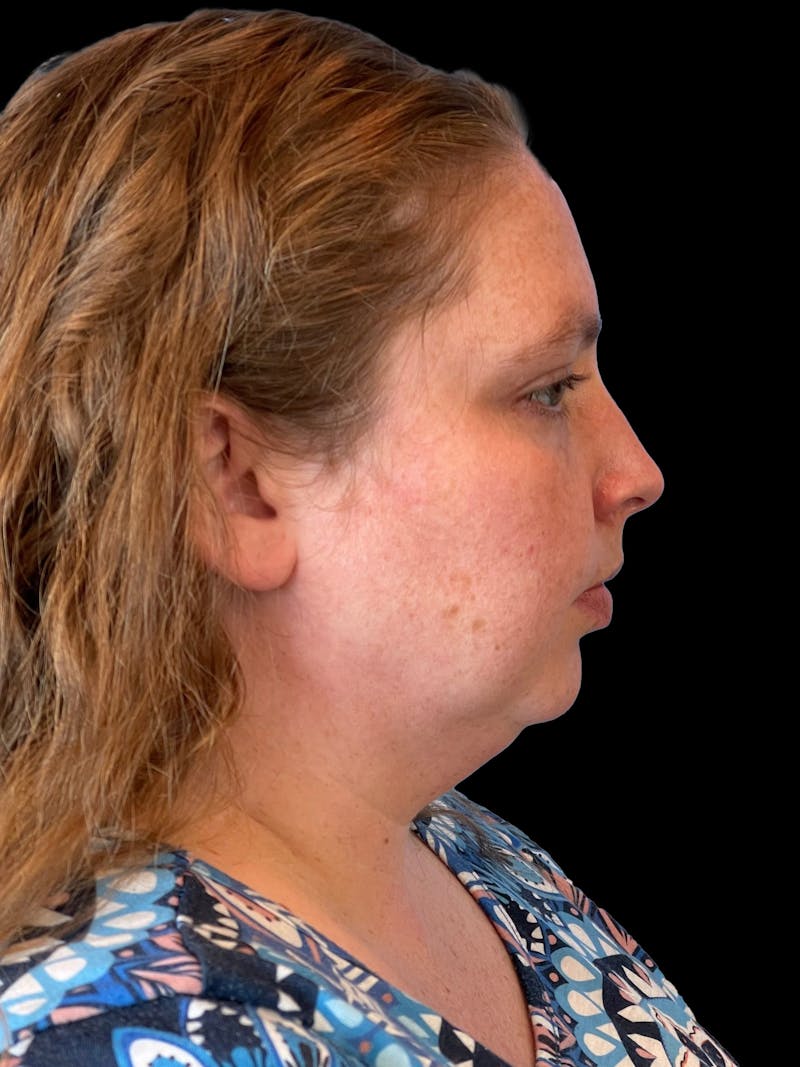 Necklift Before & After Gallery - Patient 683068 - Image 9