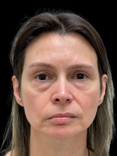 Blepharoplasty Before & After Gallery - Patient 241354 - Image 1